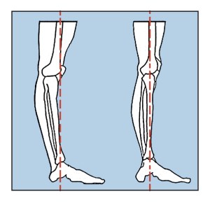 Hyperextended Knee Joint. Vertical Leg.